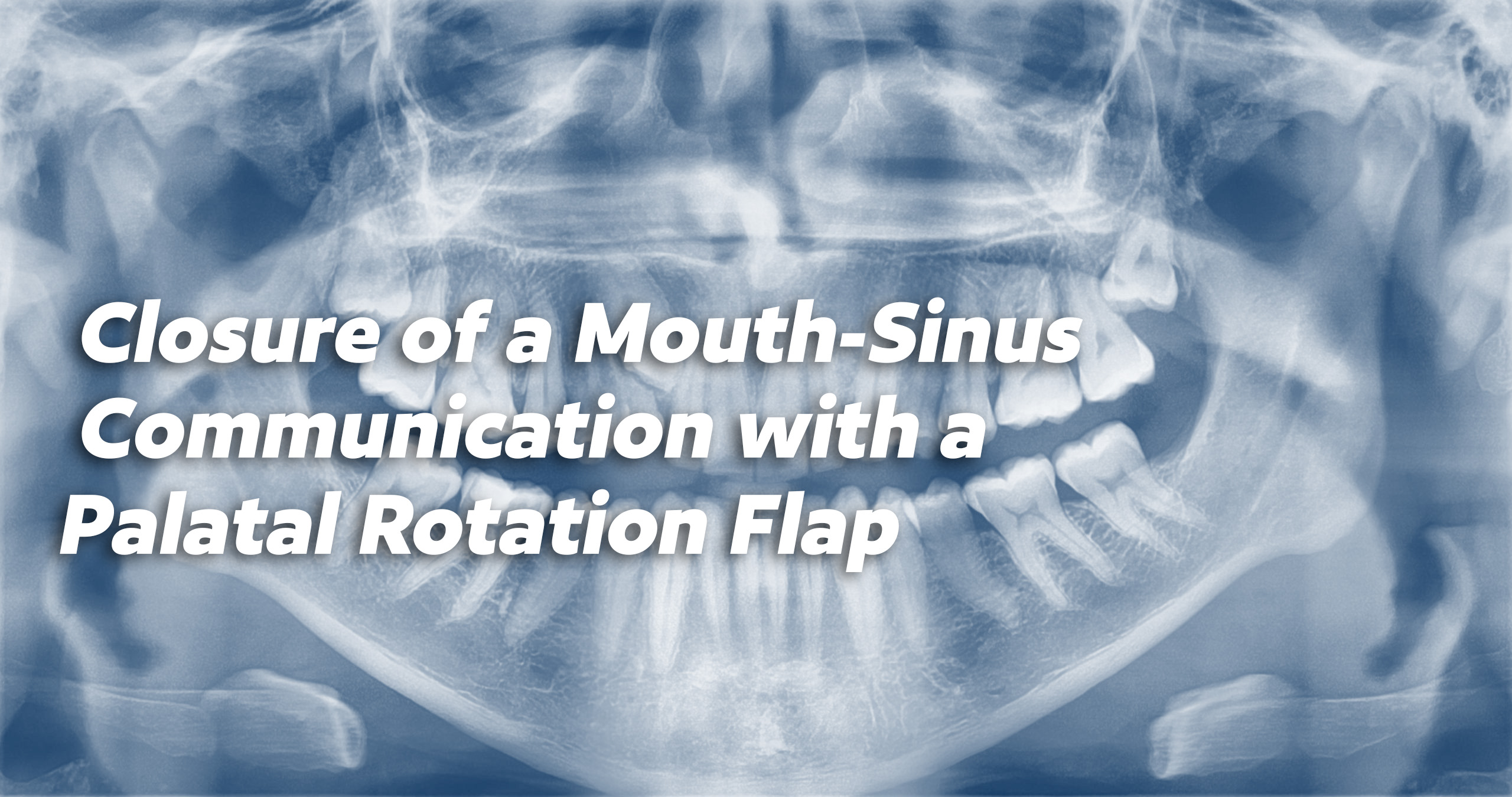 Closure of Oro-Antral Communications